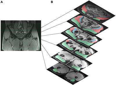 Gluteal Muscle Atrophy and Increased Intramuscular Lipid Concentration Are Not Mitigated by Daily Artificial Gravity Following 60-Day Head-Down Tilt Bed Rest